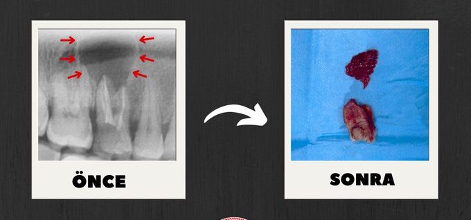 Ağız ve Diş Sağlığı Hastanesi’nde başarılı kist ameliyatı