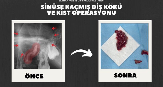 Sinüse kaçan diş kökü ve kist çıkarıldı