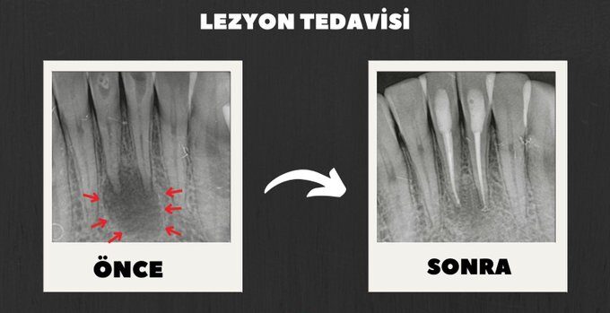 Ağız ve Diş Sağlığı Hastanesi’nde başarılı tedavi