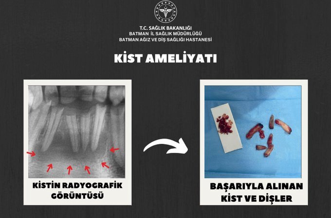20 Yaşındaki Hastaya Başarılı Kist Operasyonu