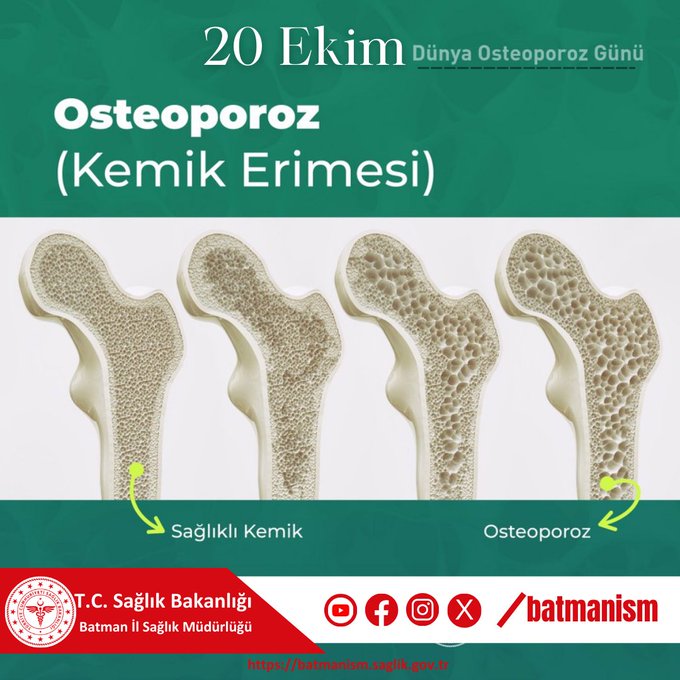 İl Sağlık Müdürlüğü’nden Osteoporoz Uyarısı: Kemik Sağlığınıza Dikkat Edin