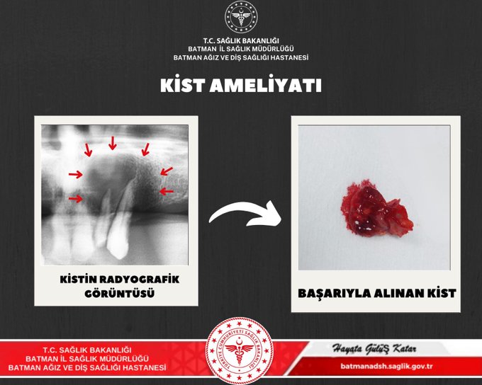 ADSH’de Başarılı Kist Operasyonu
