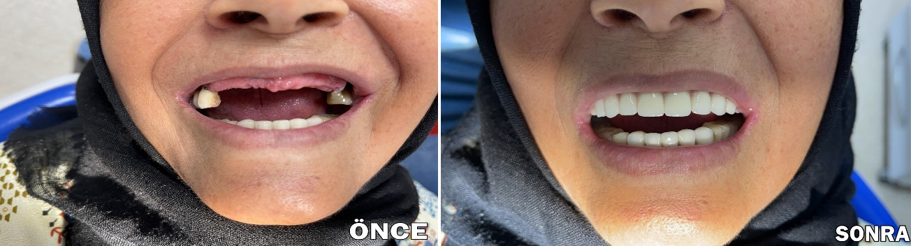 63 Yaşındaki hastaya başarılı İmplant tedavisi