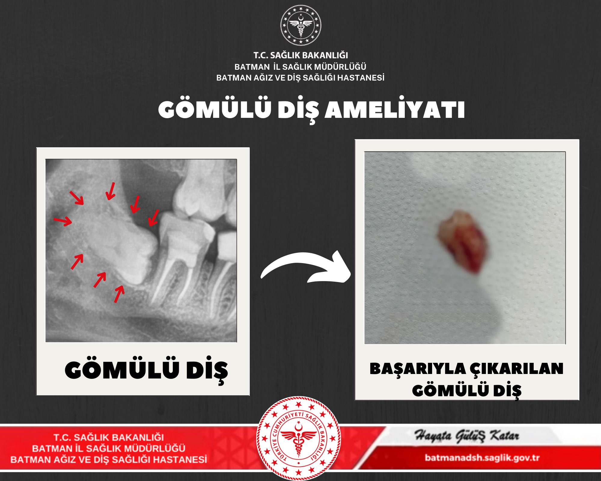 Batman Ağız ve Diş Sağlığı Hastanesi’nde başarılı Çene Cerrahisi Operasyonu