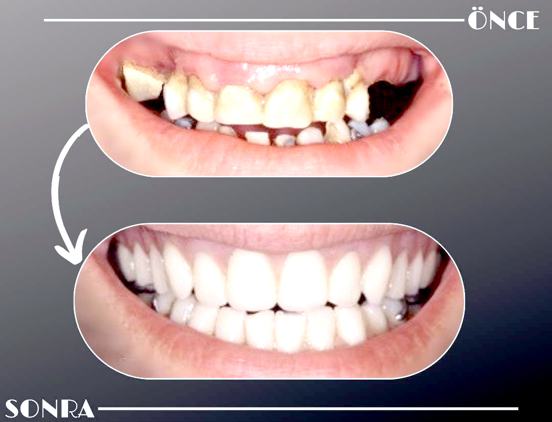 Batman Ağız ve Diş Sağlığı’nda başarılı Protetik tedavi