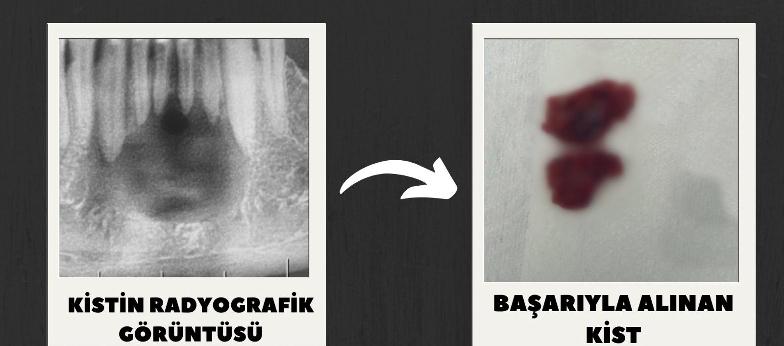Diş Sağlığı Hastanesi’nde Başarılı Çene Kisti Operasyonu