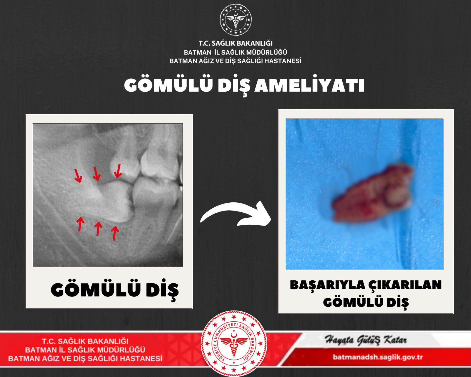 Gömülü yirmi yaş dişi başarıyla alındı