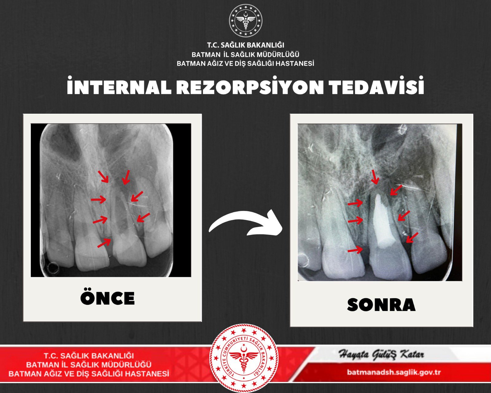 İnternal Rezorpsiyon teşhisi konulan hastanın dişi kurtarıldı