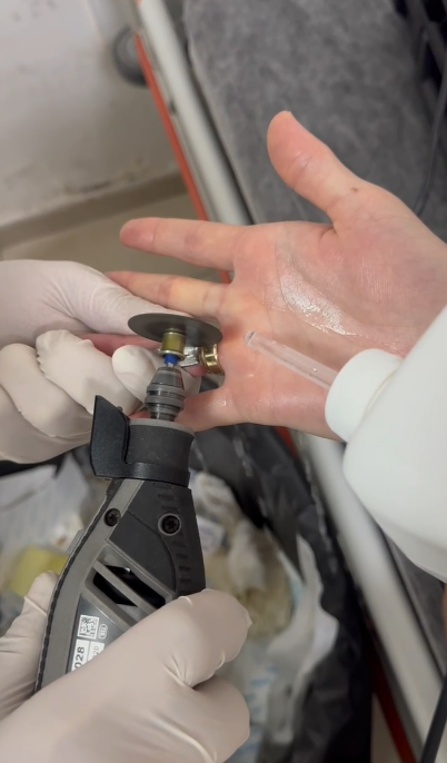 Sıkışan Yüzük İtfaiye Ekipleri Tarafından Çıkarıldı