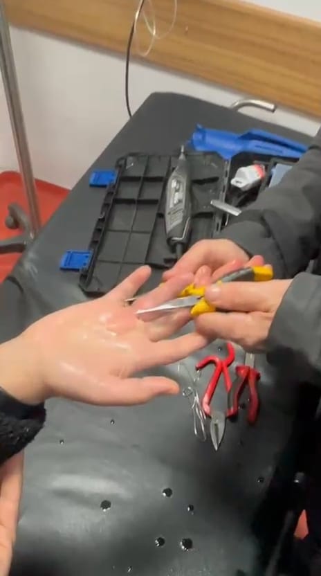 Sıkışan Yüzük İtfaiyenin Titiz Çalışmasıyla Çıkarıldı