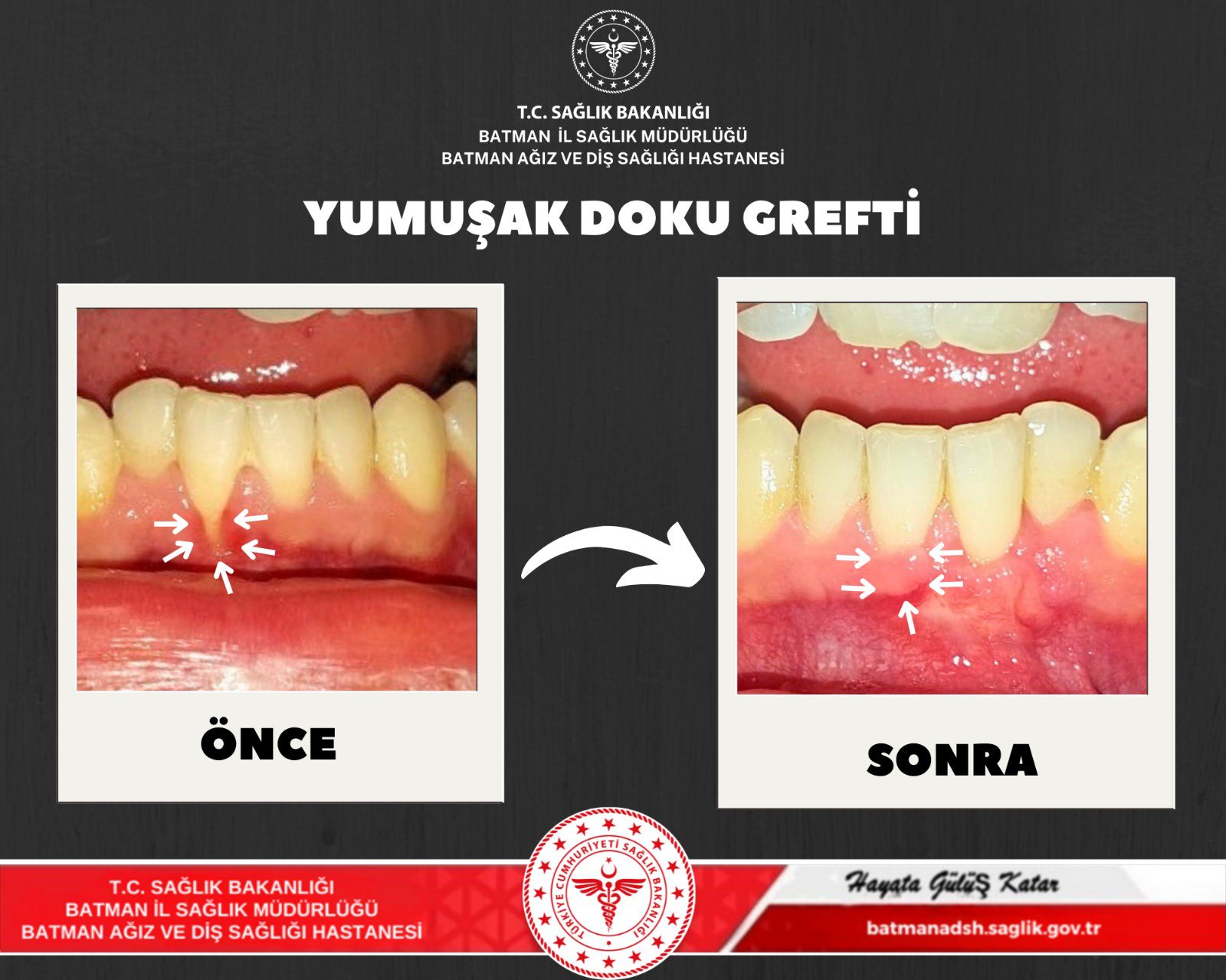 Ağız ve Diş Sağlığı Hastanesi’nden Başarılı Diş Eti Tedavisi