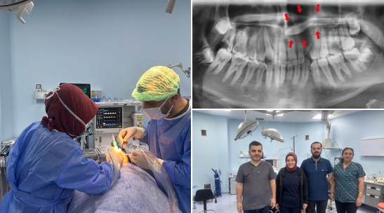 Burun Tabanındaki Gömülü Diş Başarıyla Alındı